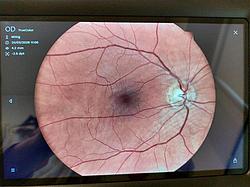 Netzhaut im Detail Aufnahme einer Netzhaut mit sichtbaren Blutgefäßen und Sehnervenkopf auf einem Bildschirm.