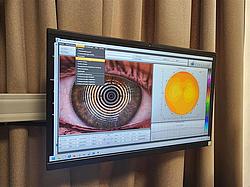 Digitale Auswertung der Augenanalyse Bildschirm mit Software zur Analyse eines Auges inklusive grafischer Auswertung.